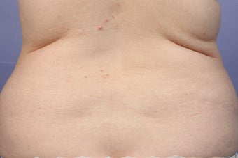 CoolSculpting to Bra Rolls/Back Fat