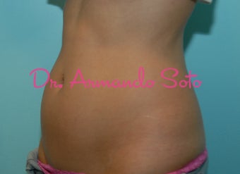 Coolsculpting by Zeltiq