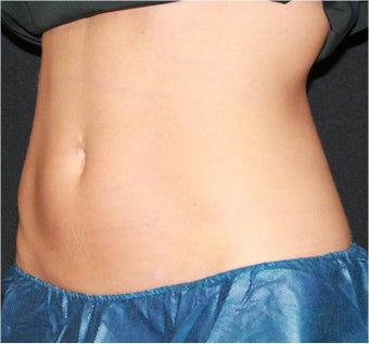 CoolSculpting