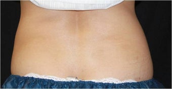 CoolSculpting
