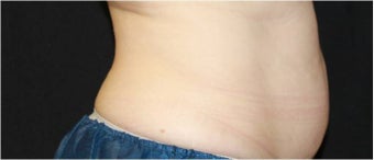 CoolSculpting