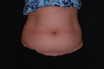 CoolSculpting