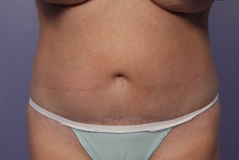 CoolSculpting to Abdomen