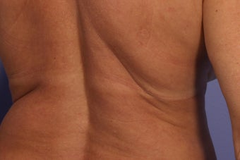 CoolSculpting to Bra/Back Rolls