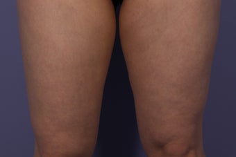 CoolSculpting Inner Thighs