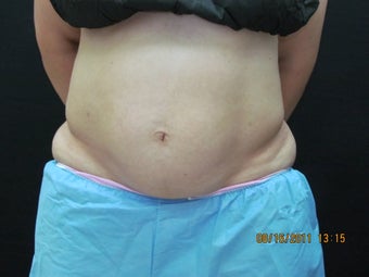 CoolSculpting