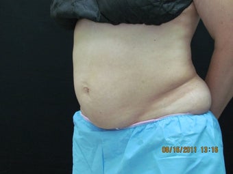CoolSculpting