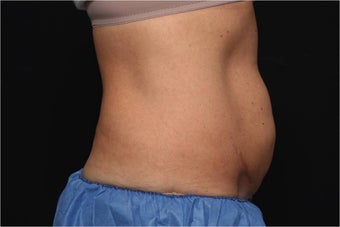 NonInvasive Fat Removal with CoolSculpting - Invented by Dr. Dieter Manstein