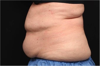 NonInvasive Fat Removal with CoolSculpting - Invented by Dr. Dieter Manstein
