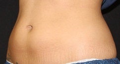 Coolsculpting-lower abdomen