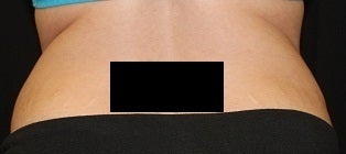Coolsculpting - Flanks