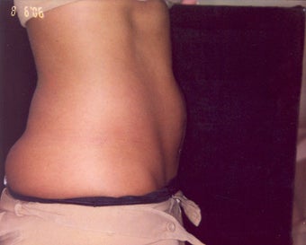 Coolsculpting Treatment