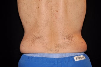 CoolSculpting