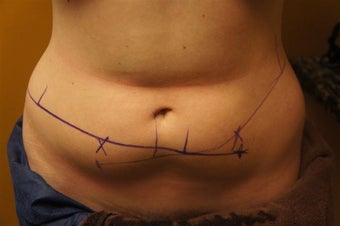 Zeltiq CoolSculpting