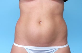 CoolSculpting