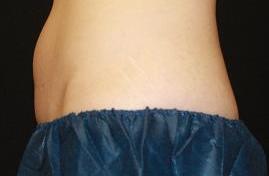 CoolSculpting - FreezeThisFat