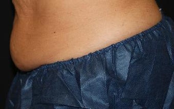 CoolSculpting - FreezeThisFat