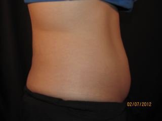 Coolsculpting