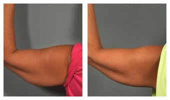 CoolSculpting