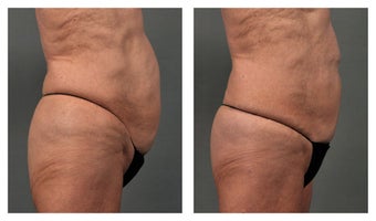 CoolSculpting Abdomen
