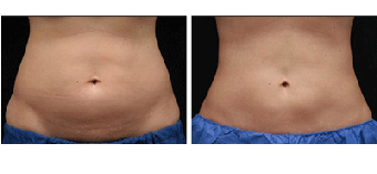 Coolsculpting