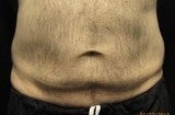 CoolSculpting
