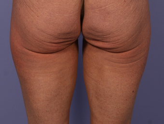 CoolSculpting to Banana Roll, Upper Posterior Thighs