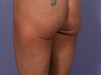 CoolSculpting to Banana Roll/ Upper, Posterior thigh