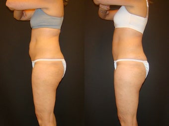 CoolSculpting