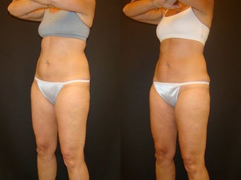 CoolSculpting