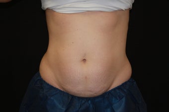 Coolsculpting - Non Invassive Fat Reduction