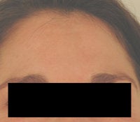 Melasma Treatment 