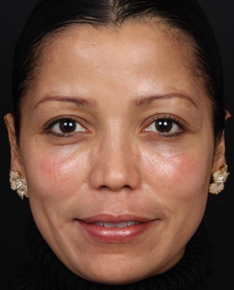 Cosmelan MD for Facial Pigmentation