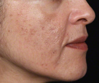 Cosmelan for Dark Spots from Acne