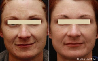 Cosmelan Advanced