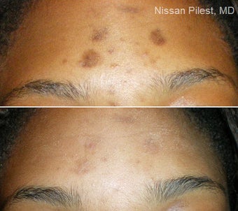 Cosmelan with SaliPeel