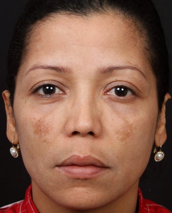 Cosmelan MD for Facial Pigmentation