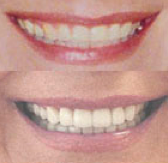 DaVinci porcelain veneers