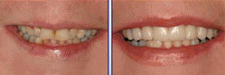 Veneers