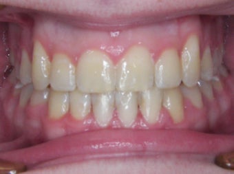 Damon Braces