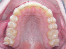 Damon Braces
