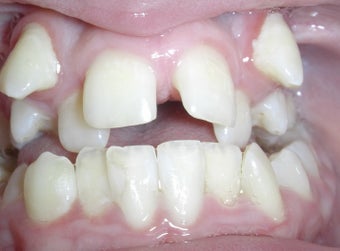 Damon Braces