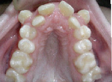 Damon Braces