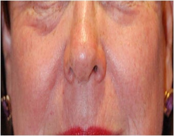 CO2 Laser Resurfacing ~ Active & Deep FX