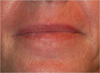 Active & Deep FX ~ CO2 Laser Skin Resurfacing