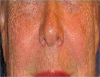 CO2 Laser Resurfacing ~ Active & Deep FX