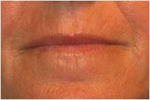 Active & Deep FX ~ CO2 Laser Skin Resurfacing