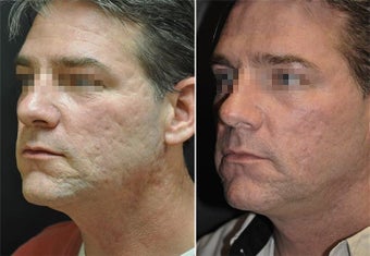 Deep FX for Acne Scarring