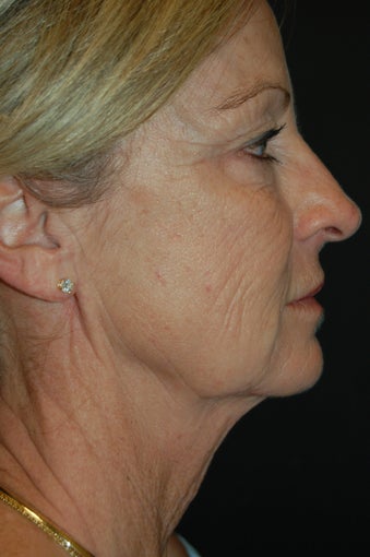 Malouf Mini-lift
