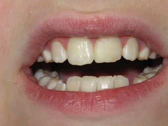 Dental Bonding #9